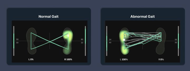 "보폭 줄이고 왼발 힘 빼세요"…AI로 환자보행 분석한다